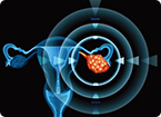 ovarian cancer, ovarian tumor, toxoplasma gondii, effector proteins, immunotherapy