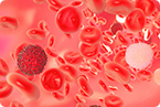 multiple myeloma