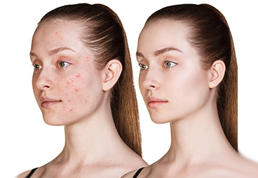 A New Vaccine for Acne Could Become A Reality Soon