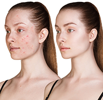New Vaccine for Acne Picture