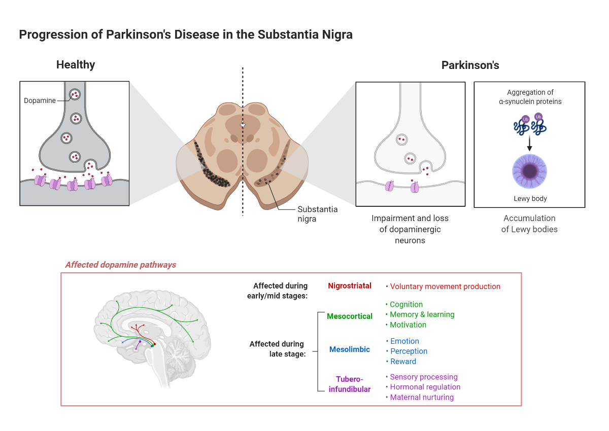 Progression of Parkinson's Disease in the Substantia Nigra
