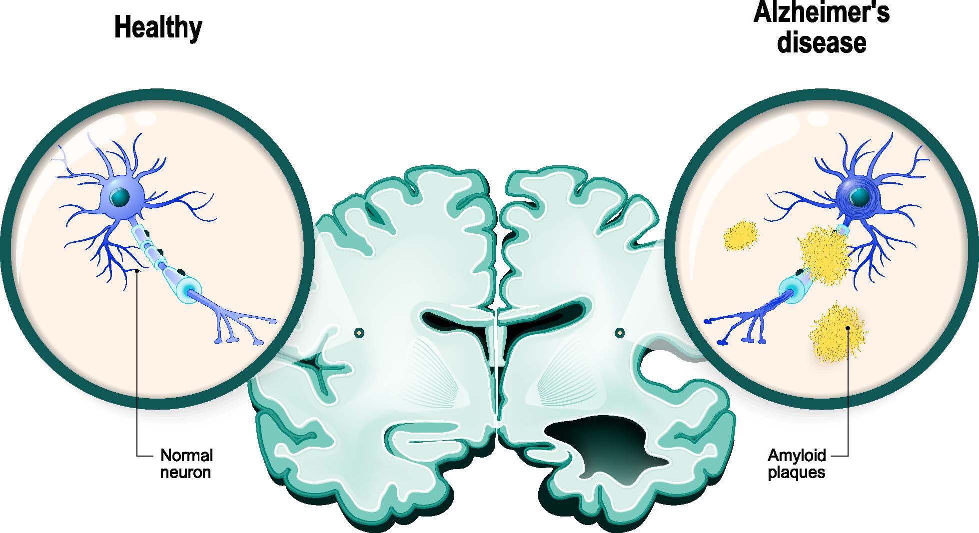 Neuron- Healthy vs Alzheimer's disease