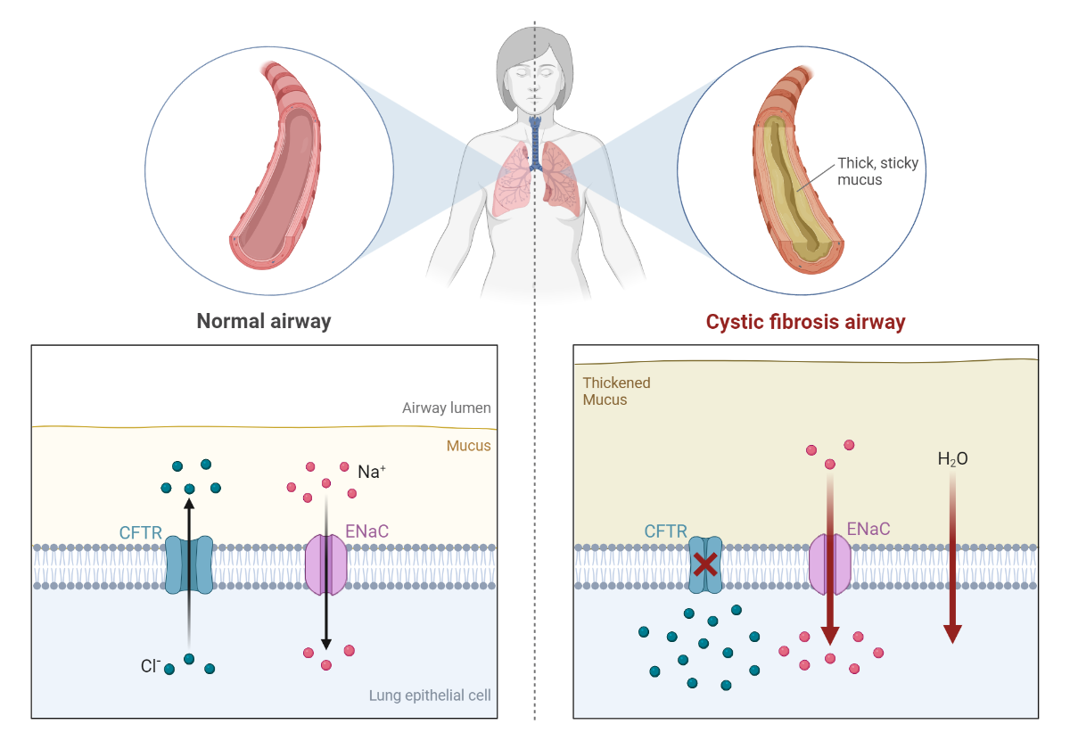 Cystic Fibrosis Airways