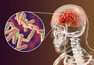 Destroying NETs that hide bacteria as a way to treat acute bacterial meningitis