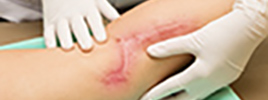 Nature-Inspired Glue for Scarless Skin Regeneration