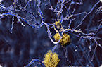 Tau protein, Alzheimer's